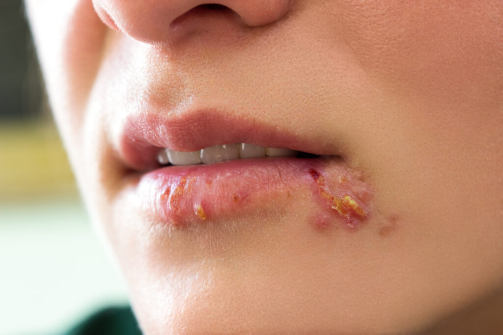 Lippen einer Frau sind übersät mit verkrusteten Bläschen, wie sie bei Lippenherpes, einer häufigen Erkrankung im Mund, auftreten.