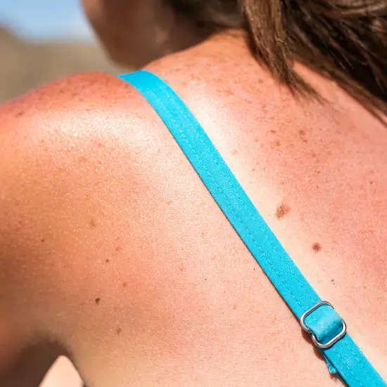 Sonnenbrand: Rückenansicht einer Frau im Bikini Rückenansicht einer Frau im Bikini: Das lange Sonnenbad hat einen Sonnenbrand verursacht.
