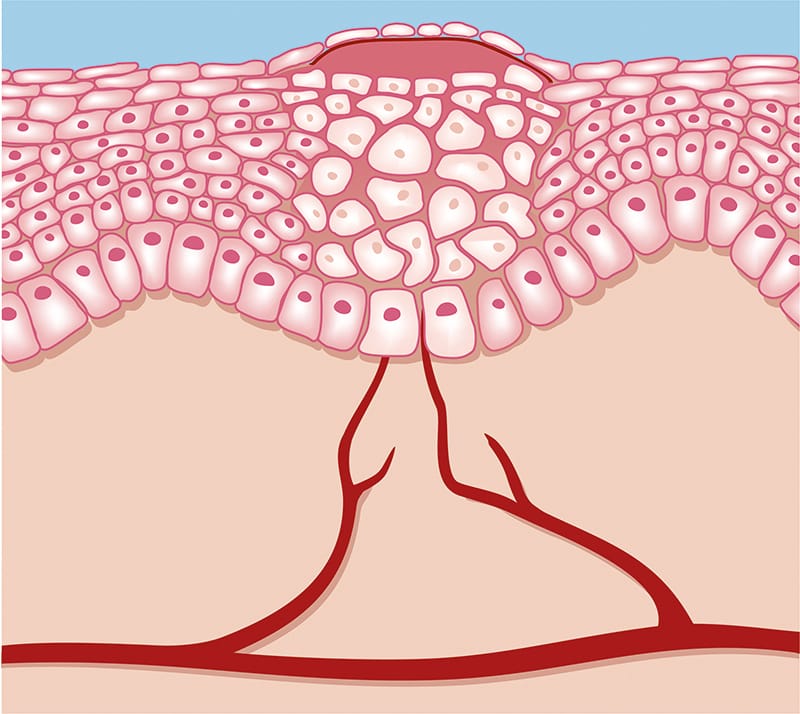 Wundheilung Epithelisierung