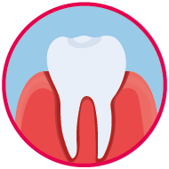 Icon für einen Zahn mit Gingivitis.
