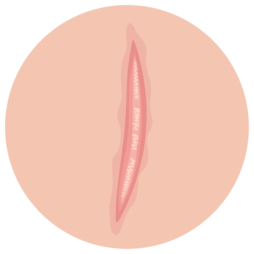 Hypertrophe Narben