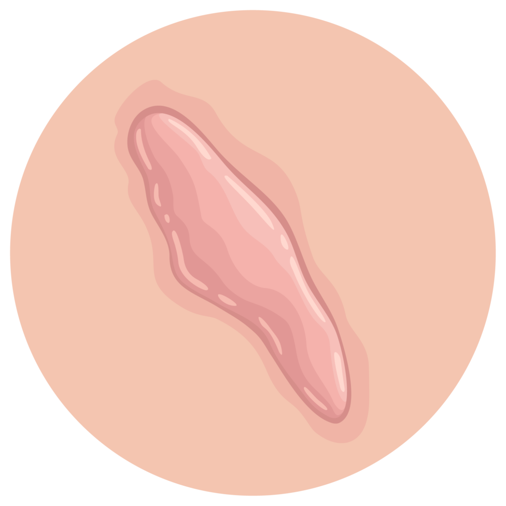 Keloide