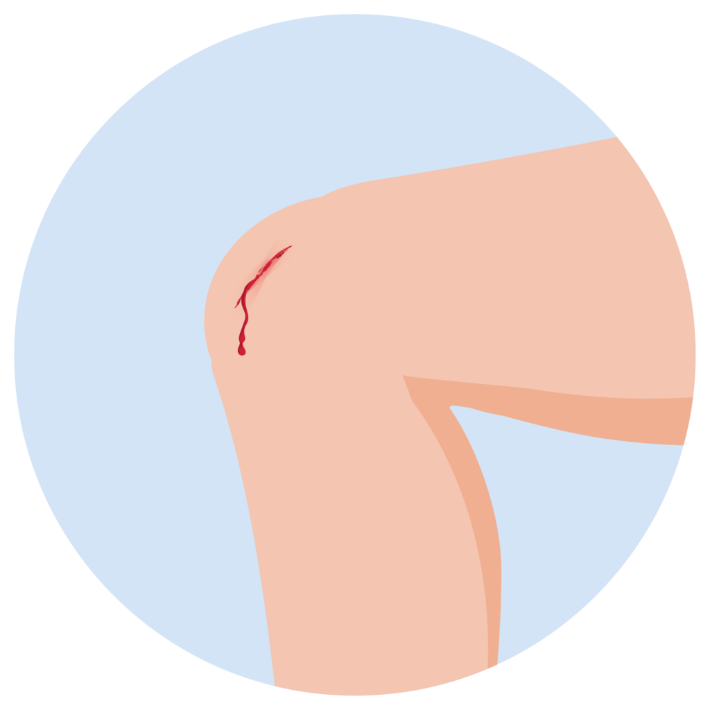 Offene Wunde am Knie, bei der die Blutung gestoppt werden muss.