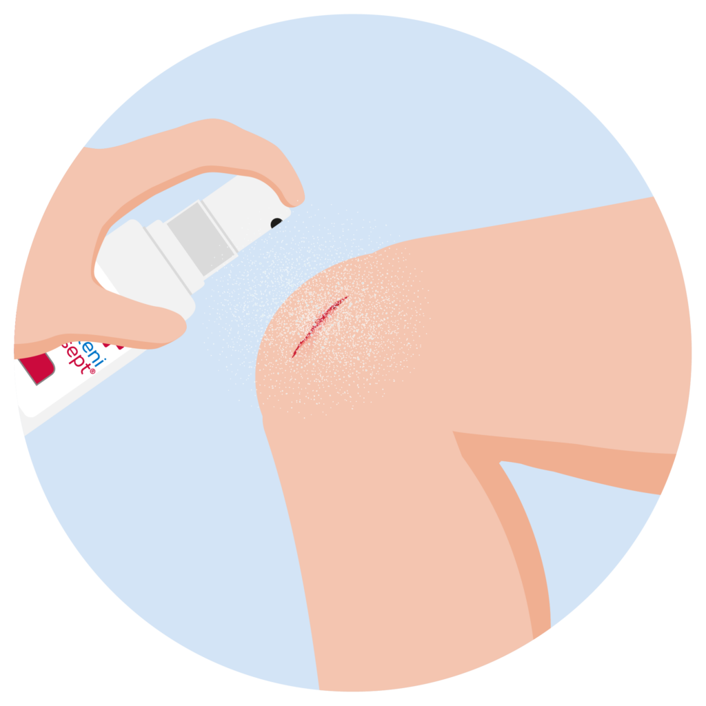 Knie wird mit octenisept® Wund-Desinfektionsspray desinfiziert, um Keime abzutöten und Entzündungen vorzubeugen